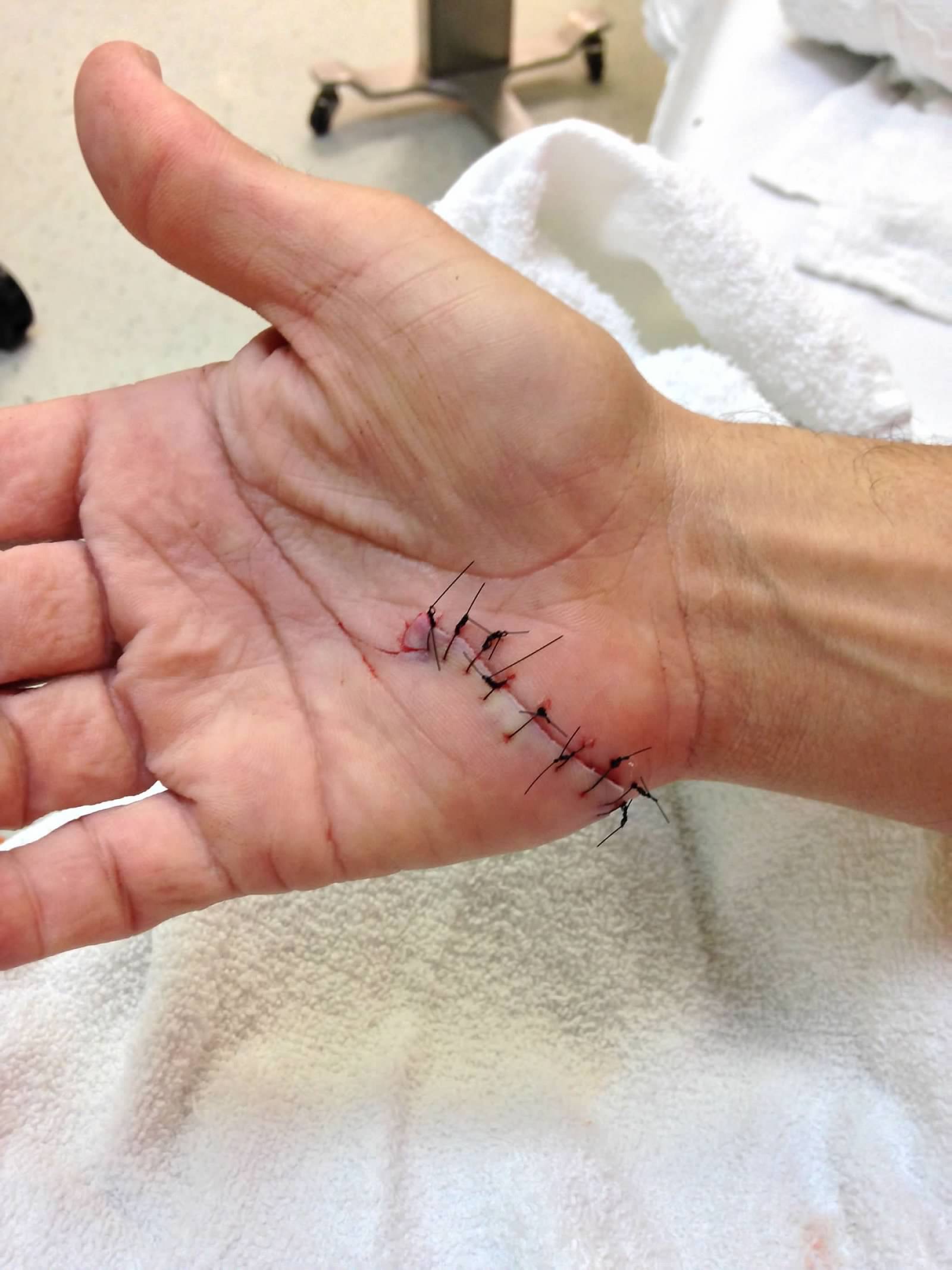 Hand laceration with stitches — trail fall, emergency room