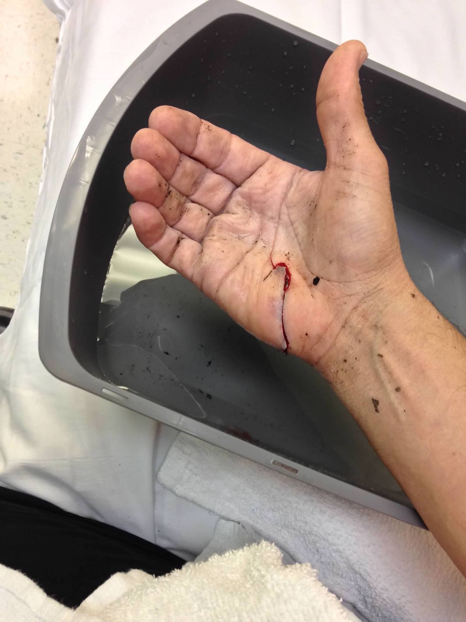 Trail running hand laceration after a fall